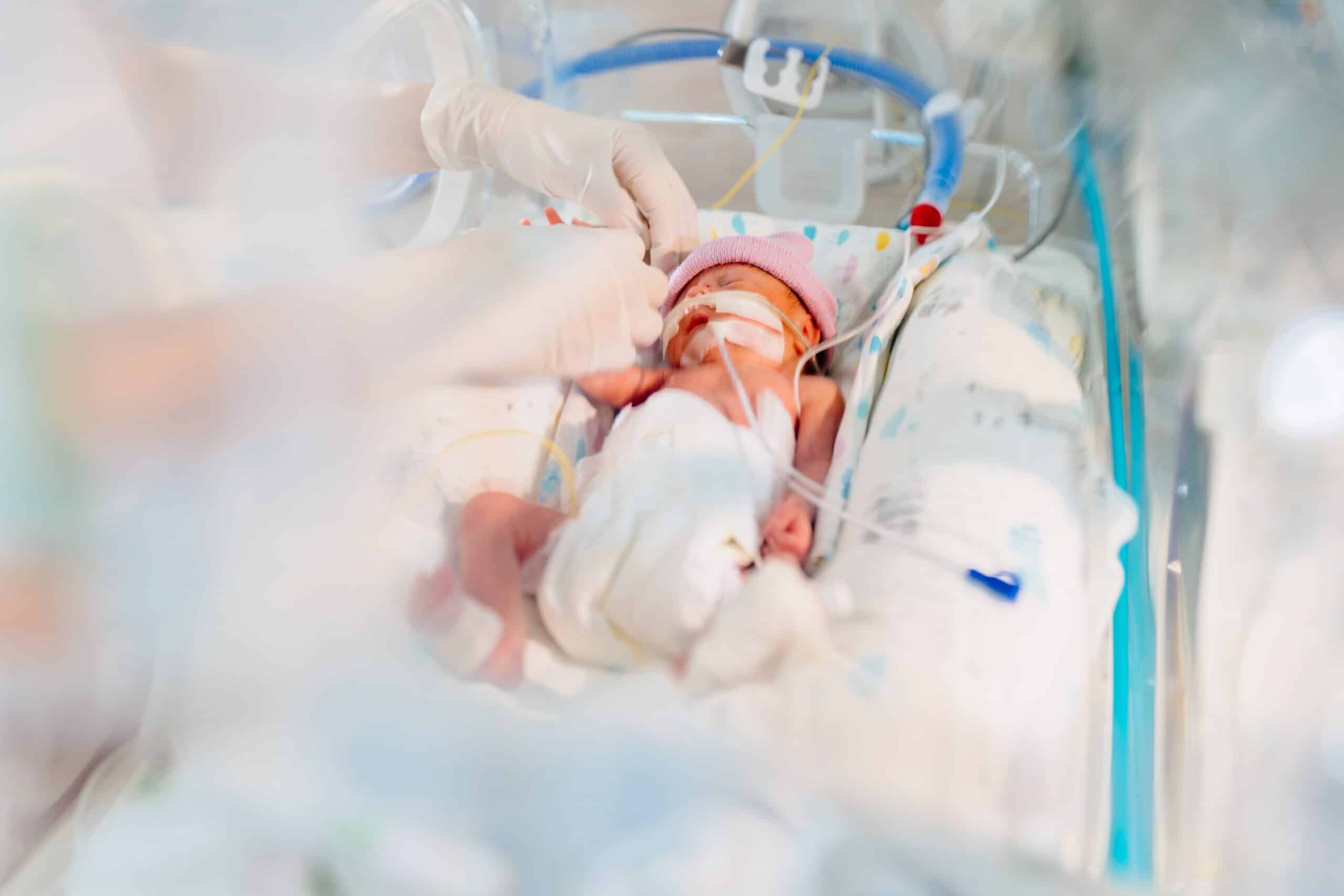 Neonatologia – Prematuros estão mais expostos a eventos adversos nos primeiros dias de internação