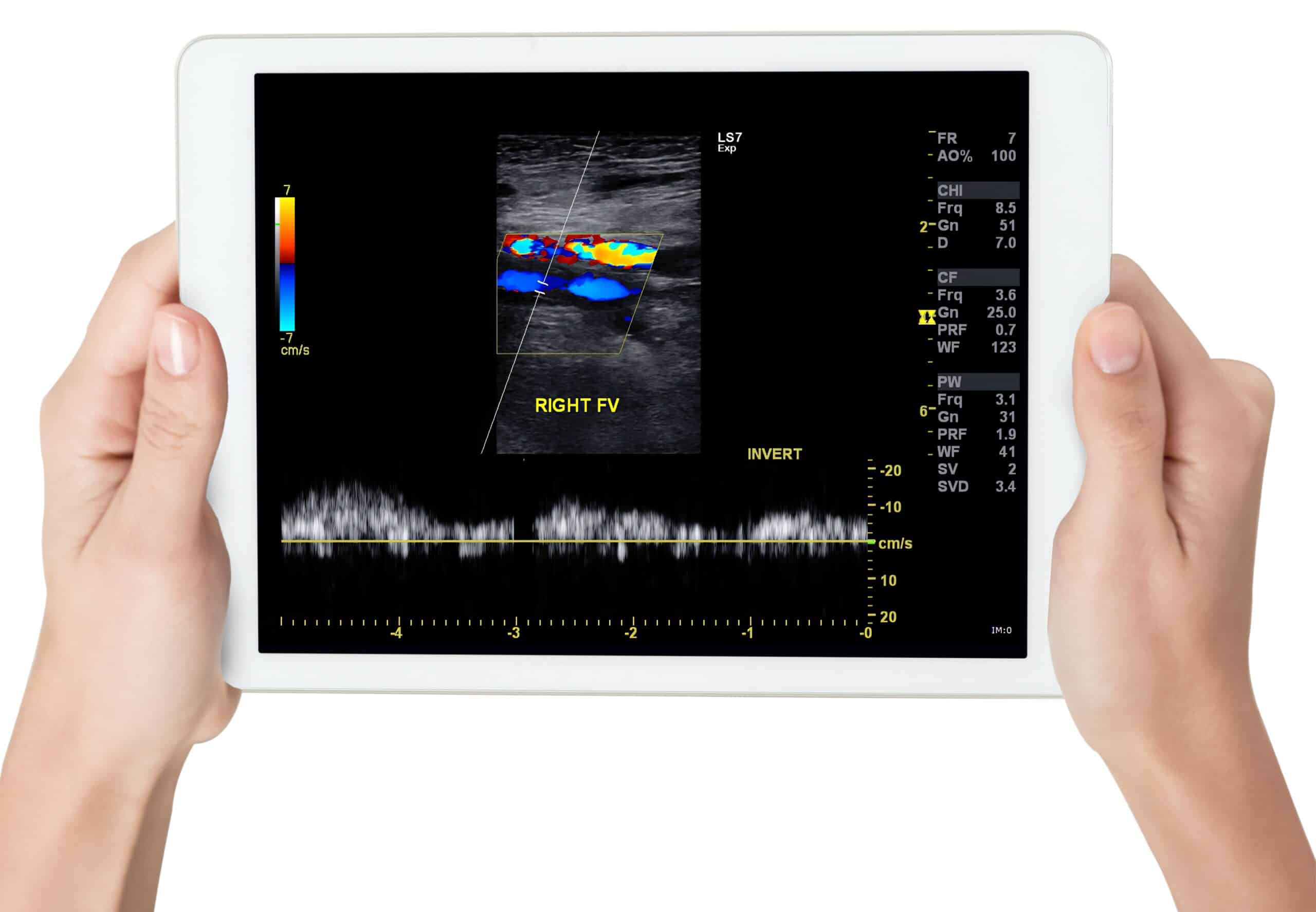 Inteligência artificial e segurança do paciente: novas perspectivas para a prevenção do TEV